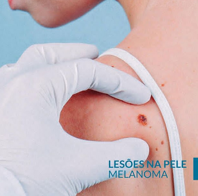 Lesões na pele – Melanoma