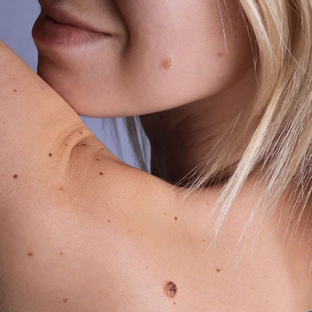 Pintas: Excisão Cirúrgica