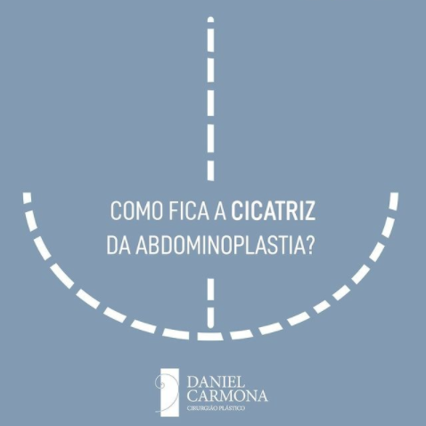Como fica a cicatriz da abdominoplastia?