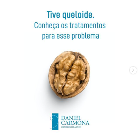 Tive Queloide. Conheça os tratamentos para essa doença.