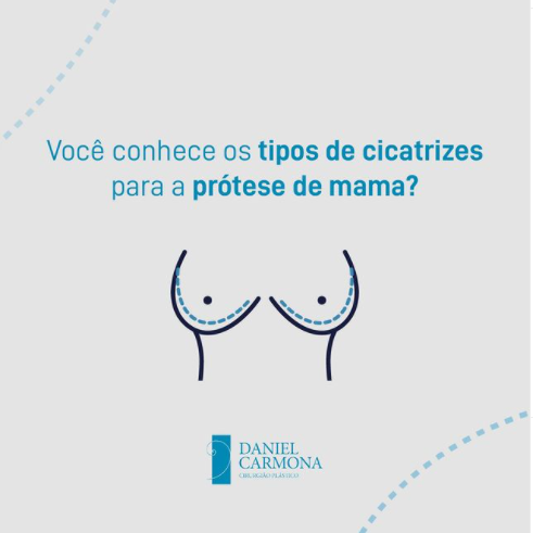 Você conhece os tipo de cicatrizes para prótese de mama?