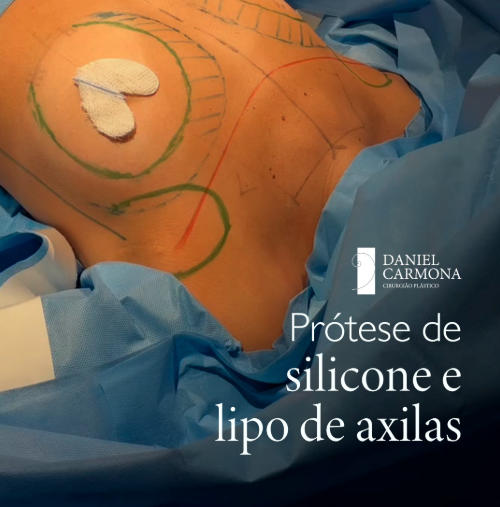 Combo dos sonhos – Prótese + Lipo de axilas
